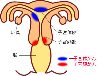 子宮がん